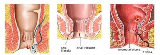 मुझे कैसे पता चलेगा कि मेरा फिस्टुला ठीक हो रहा है?